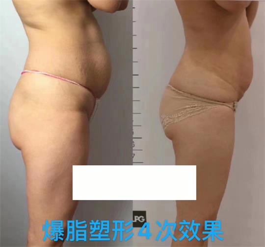 產(chǎn)后塑形美雕儀，生完孩子真的很難恢復(fù)身材？未必……