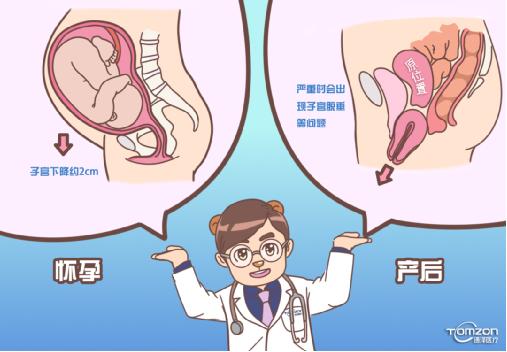 盆底康復(fù)治療儀可以解決子宮下降問(wèn)題嗎？