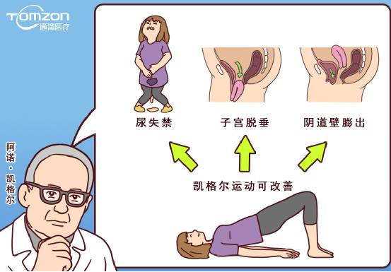 使用凱格爾球還能做盆底治療儀嗎？